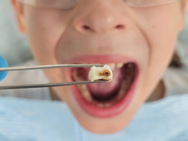Best Emergency Root Canal Treatment in Worthington Hills, KY